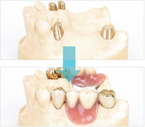 当院の入れ歯治療の特徴