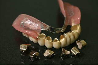 コーヌステレスコープ義歯と保険入れ歯の違い