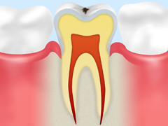 C0　ごく初期の虫歯