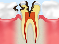 C3　神経まで達した虫歯