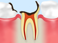 C4　歯根まで達した虫歯
